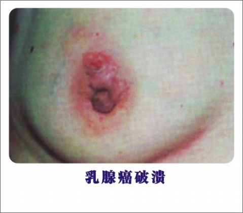 癌症,肿瘤,癌症治疗