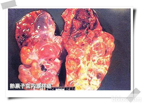 癌症,肿瘤,癌症治疗