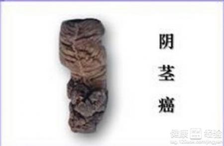 癌症,肿瘤,癌症治疗,癌症预防,肿瘤医院