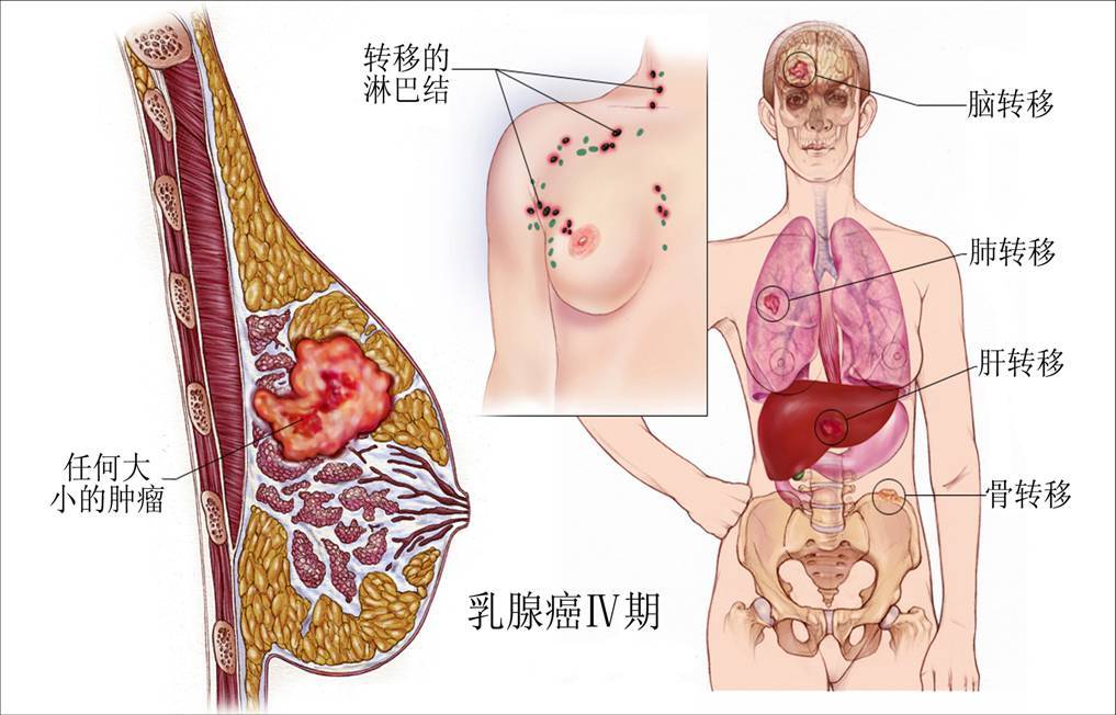 乳腺癌有几种类型