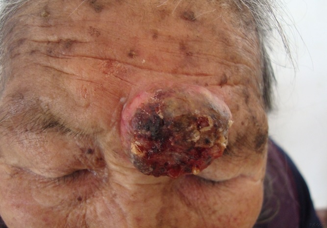癌症前期的18种预兆 癌症前期的18种预兆皮肤变化