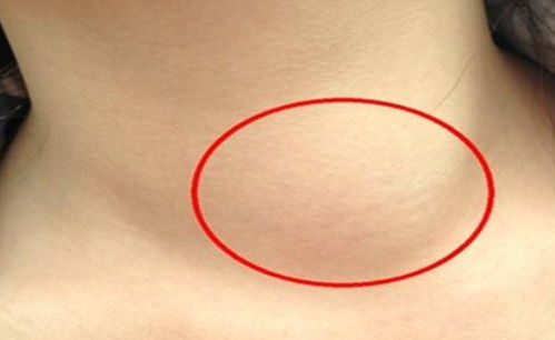 癌症晚期疼痛时瞳孔增大 癌症晚期疼痛时瞳孔增大