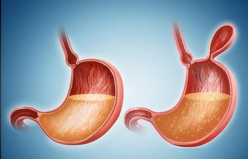 浸润性结节一定是癌症吗 浸润性结节一定是癌症吗