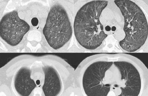 ��ʳ�ΰ�֢ ������ʳ������֢