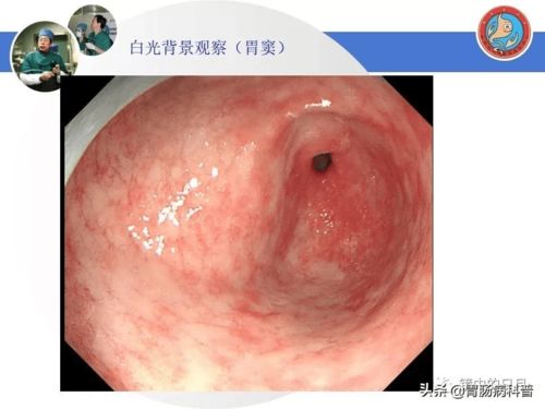 右边偏头痛是癌症吗 右边偏头痛为什么 右边偏头痛是癌症吗 右边偏头痛为什么