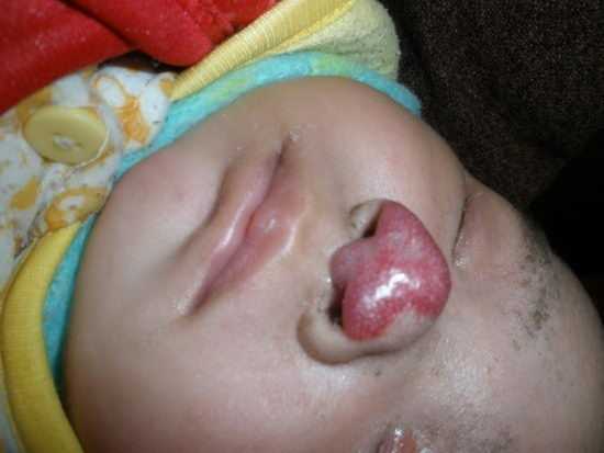 胆囊炎转变为癌症的几率 胆囊炎转变为癌症的几率