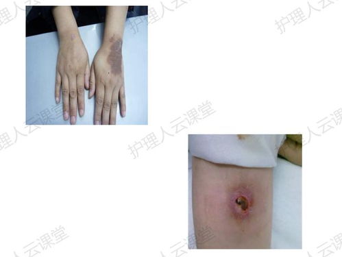 癌症一只脚疼_癌症病人脚疼是哪里转移了 癌症一只脚疼_癌症病人脚疼是哪里转移了