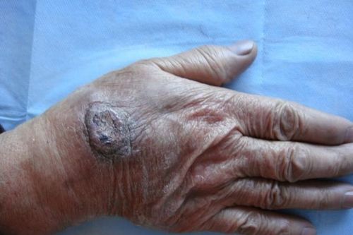 过度自慰会引起癌症吗 过度自慰会引起癌症吗