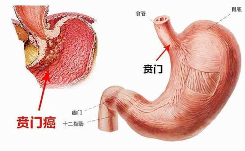 东山隆起癌症 东山隆起频 东山隆起癌症 东山隆起频