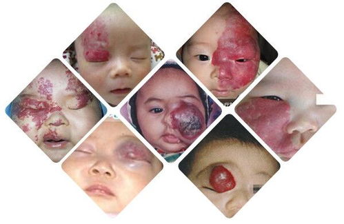 Ԥ������ת��֢������