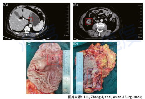 癌症胸腺转移 胸腺转移瘤严重吗 癌症胸腺转移 胸腺转移瘤严重吗