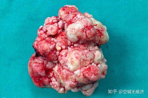 ���ٰ�֢�ܺ���ĸ������