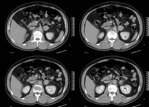 ��֢����Ѫ�����������