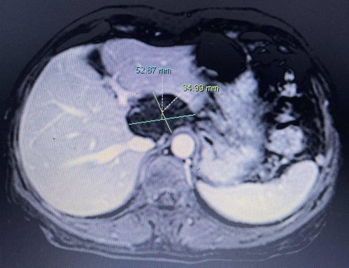 帅哥确诊癌症 帅哥确诊癌症视频 帅哥确诊癌症 帅哥确诊癌症视频
