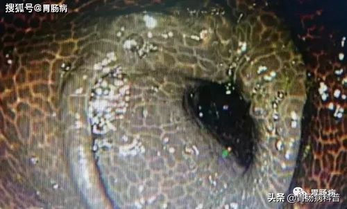 编制内得了癌症怎么办 编制内得了癌症怎么办