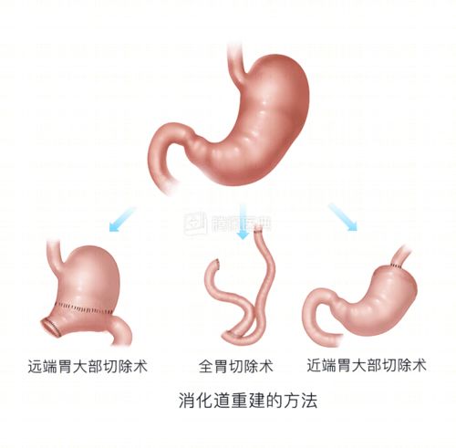 宫颈可疑腺癌就是癌症么 宫颈可疑腺癌就是癌症么