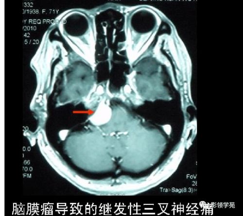 癌症标志物在什么范围内 癌症标志物在什么范围内