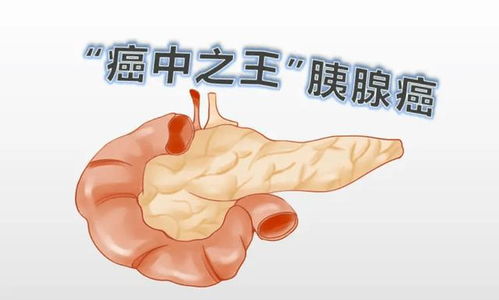腹部ct只能查是否癌症 腹部ct只能查是否癌症