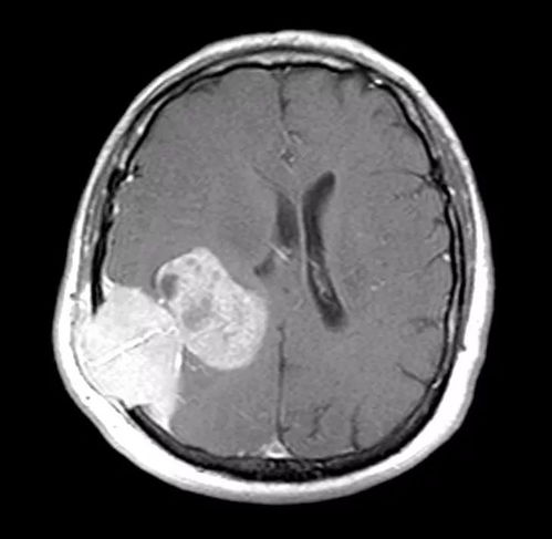癌症新突破高敏是真的吗 癌症新突破高敏是真的吗