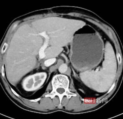 肺癌会吸二手烟得癌症吗 肺癌会吸二手烟得癌症吗
