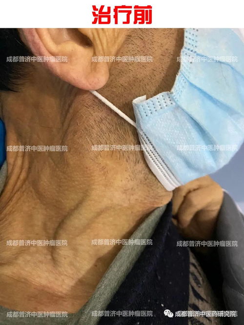 前列腺癌症手术费多少 前列腺癌症手术费多少