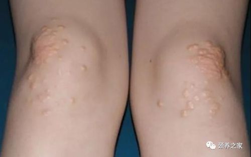 癌症早期肠胃有啥变化没 癌症早期肠胃有啥变化没