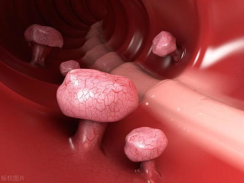 偶尔便血与癌症有关系吗 偶尔便血与癌症有关系吗