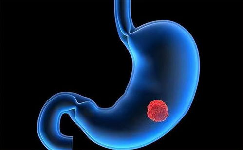 妻子癌症中医 老中医治癌症案例 妻子癌症中医 老中医治癌症案例