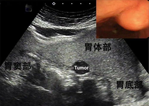 复发转移的癌症是晚期吗 复发转移的癌症是晚期吗