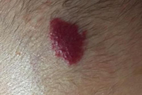 感冒了会不会是得癌症了 感冒了会不会是得癌症了