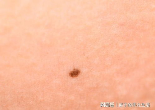 ��簩֢���� �����˰�֢ ��ô��ο��