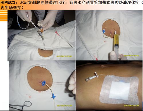 ��֢�������� ��֢����������ʲôҩ