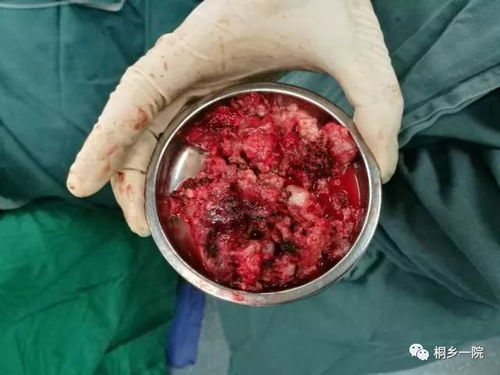 ��ʯ����֢_��ʯ�����˴�����