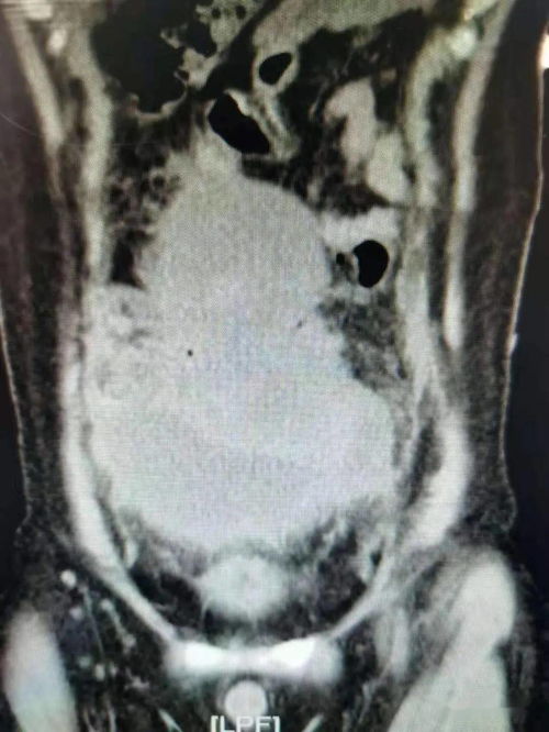 癌症晚期有几种疼痛感 癌症晚期有几种疼痛感