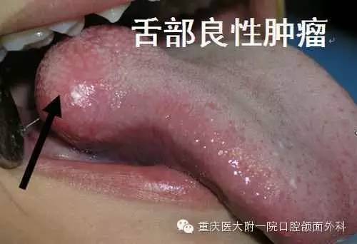 石斛治愈癌症 石斛可以治疗癌症吗 石斛治愈癌症 石斛可以治疗癌症吗