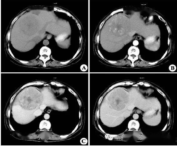 乳腺癌症状和体征包括 乳腺癌症状和体征包括