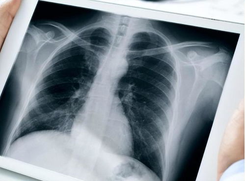 癌症会不会转移到肺部上 癌症会不会转移到肺部上