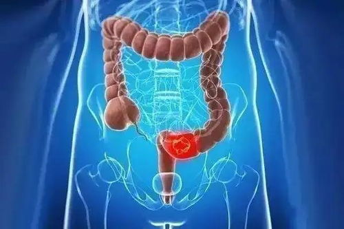 四妙散能不能治疗癌症 四妙散能不能治疗癌症