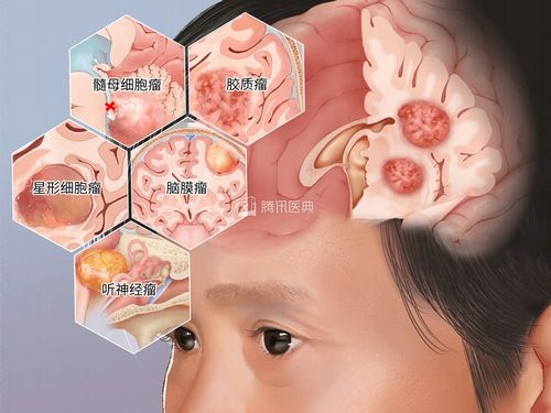 肝囊肿多大会是癌症晚期 肝囊肿多大会是癌症晚期