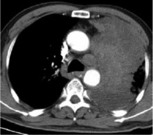 女生确证癌症 女孩得了癌症 男孩却要娶她 知道真相后害怕了 女生确证癌症 女孩得了癌症 男孩却要娶她 知道真相后害怕了