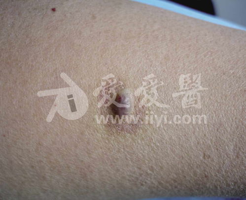 怎么样才是早期肝癌症状 怎么样才是早期肝癌症状