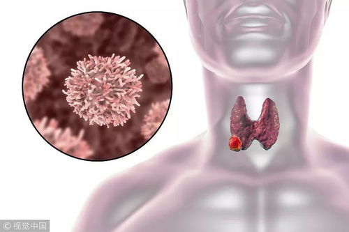印戒肠癌症状_肠印戒细胞癌5年生存率 印戒肠癌症状_肠印戒细胞癌5年生存率