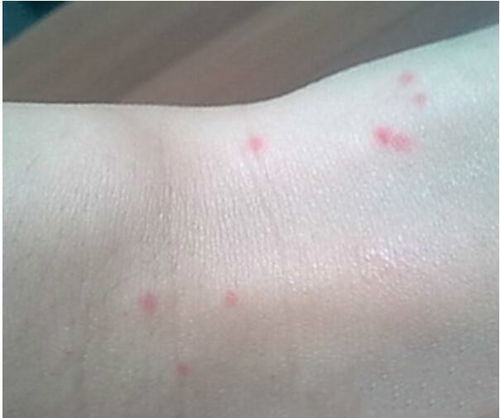 ��֢���ڻᴫȾ������