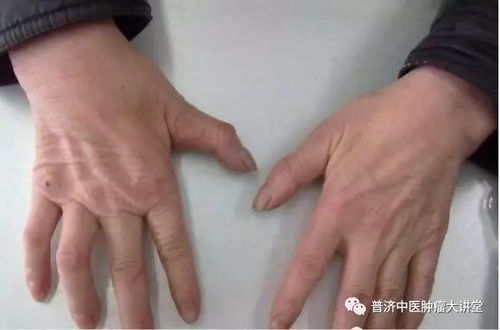 ѪҺָ���鰩֢ѪҺ��鰩֢ʲôָ�� ��ֵ�Ƕ���