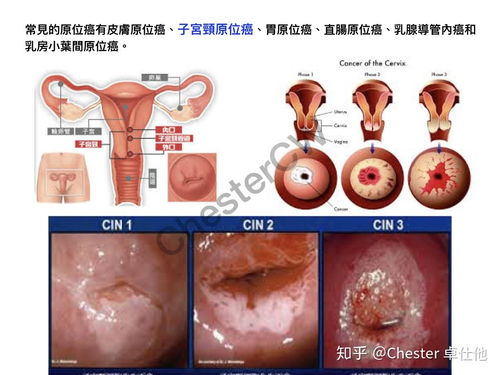 ���Ż���֢��ϱ�����ü�