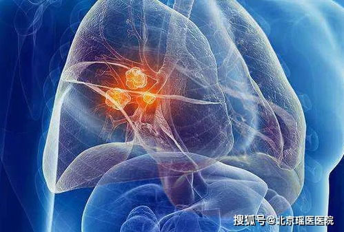 前列腺癌症扩散到腰上 前列腺癌症扩散到腰上