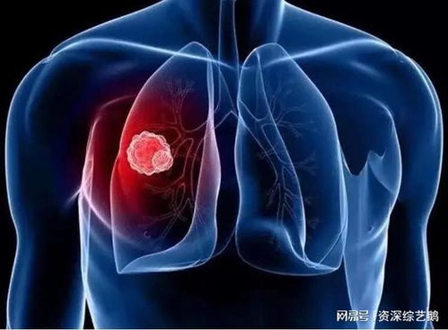 晚期胃癌症为什么难治啊 晚期胃癌症为什么难治啊