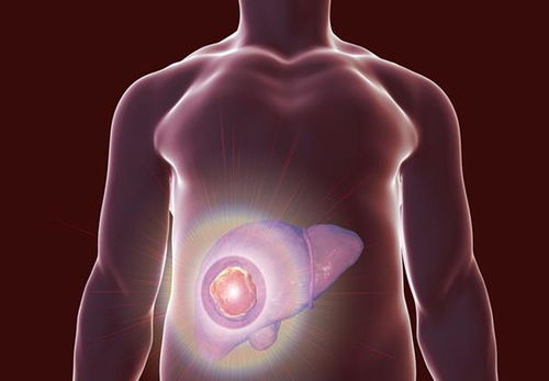 血红蛋白偏低有癌症吗 血红蛋白偏低有癌症吗