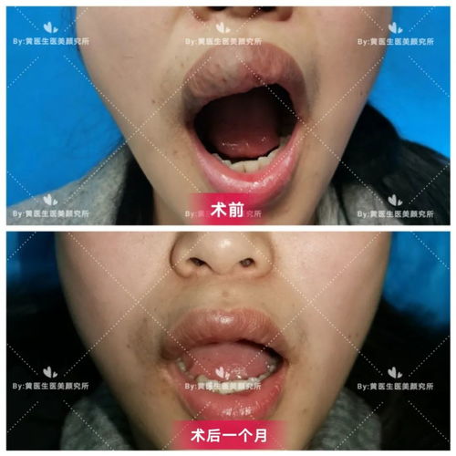 ɸ�鰩֢�Ļ���ʲô(��֢ɸ��)