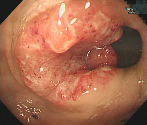 �����㰩֢(�ҽ��ð�֢����Ľ��ܲ���)